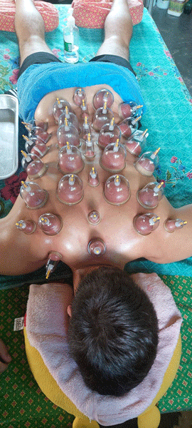 cupping therapy