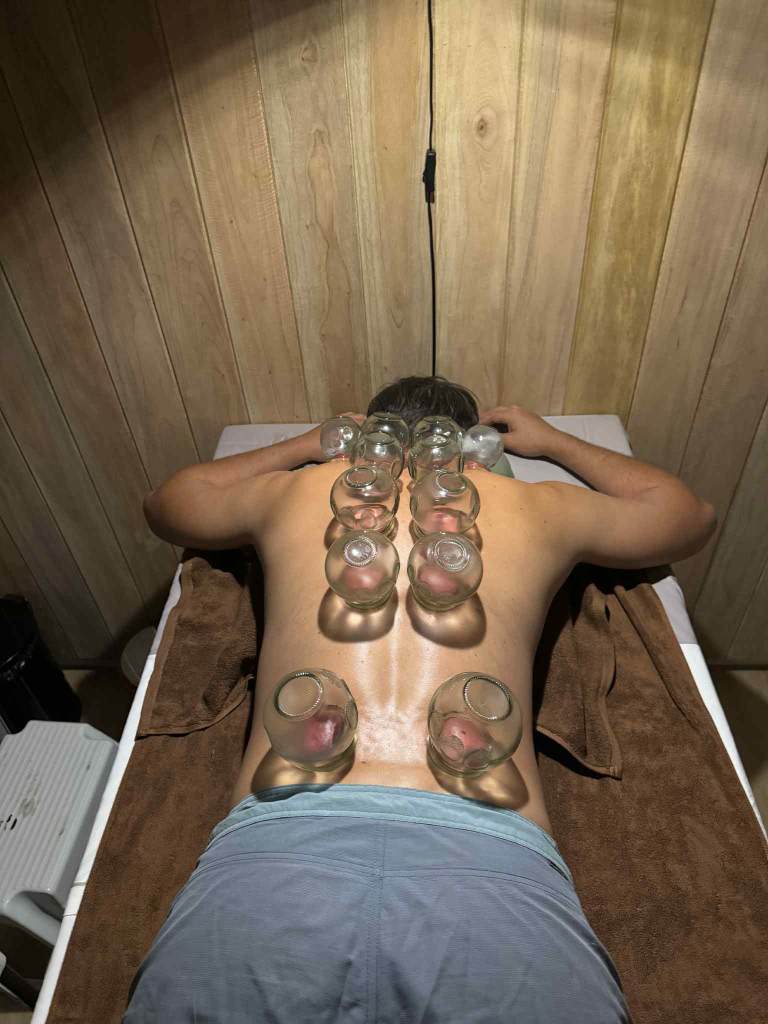 cupping